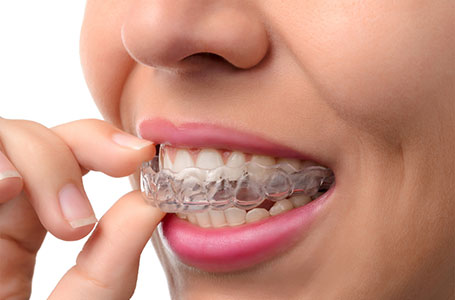 gouttieres invisalign